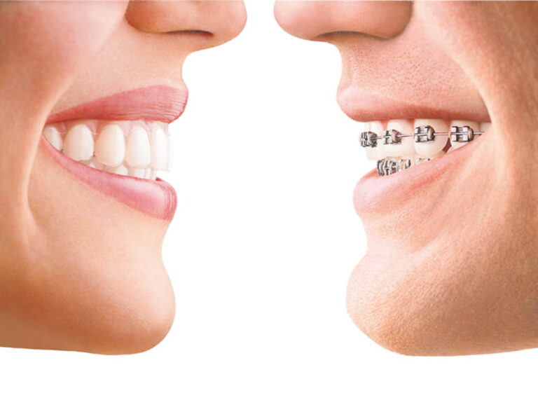 Invisalign Vs Braces Milnor Orthodontics Fort Collins Co 1378