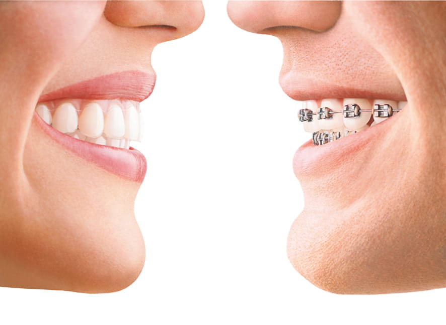 Invisalign vs. Ceramic Braces, Milnor Orthodontics