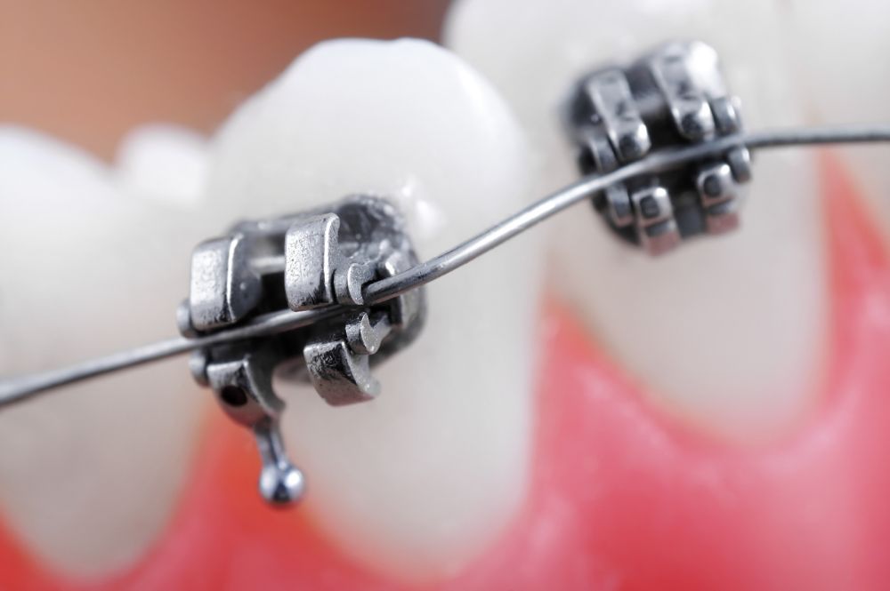 What is Space Age Wire?  Braces and Orthodontist in Fort Collins, CO