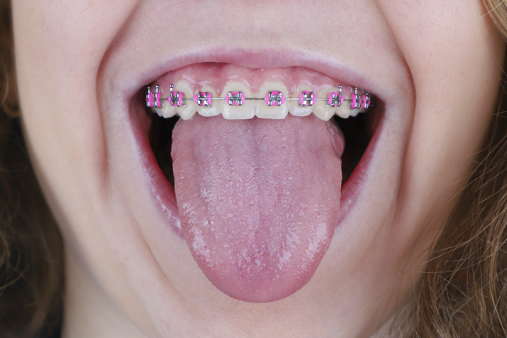 where to buy rubber for braces