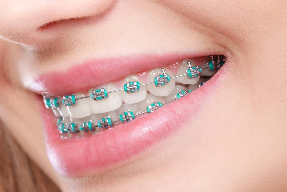 How do regular dental braces cost?