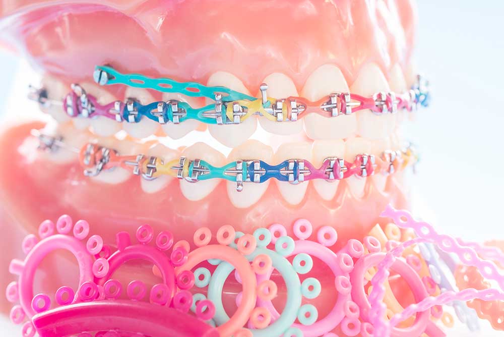 close-up-orthodontic-model-with-elastics-on-braces